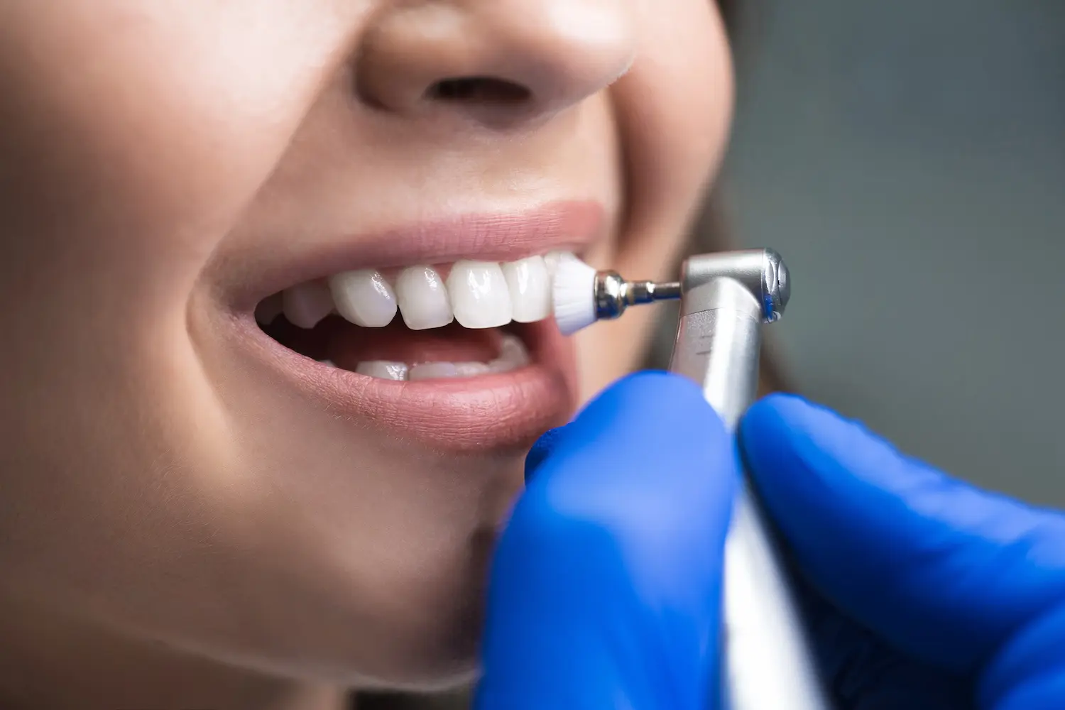 Professional Teeth Cleaning