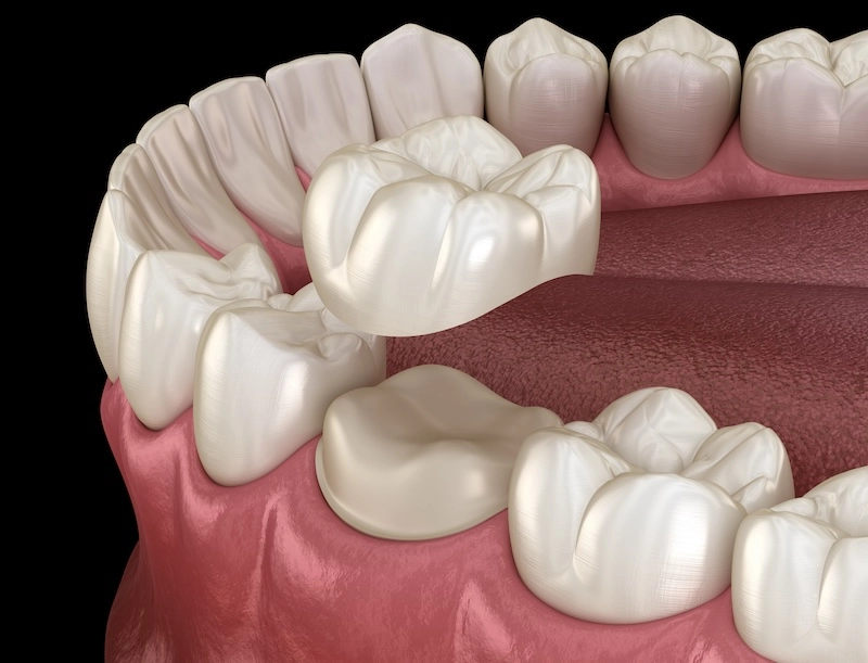 Durable Dental Crowns