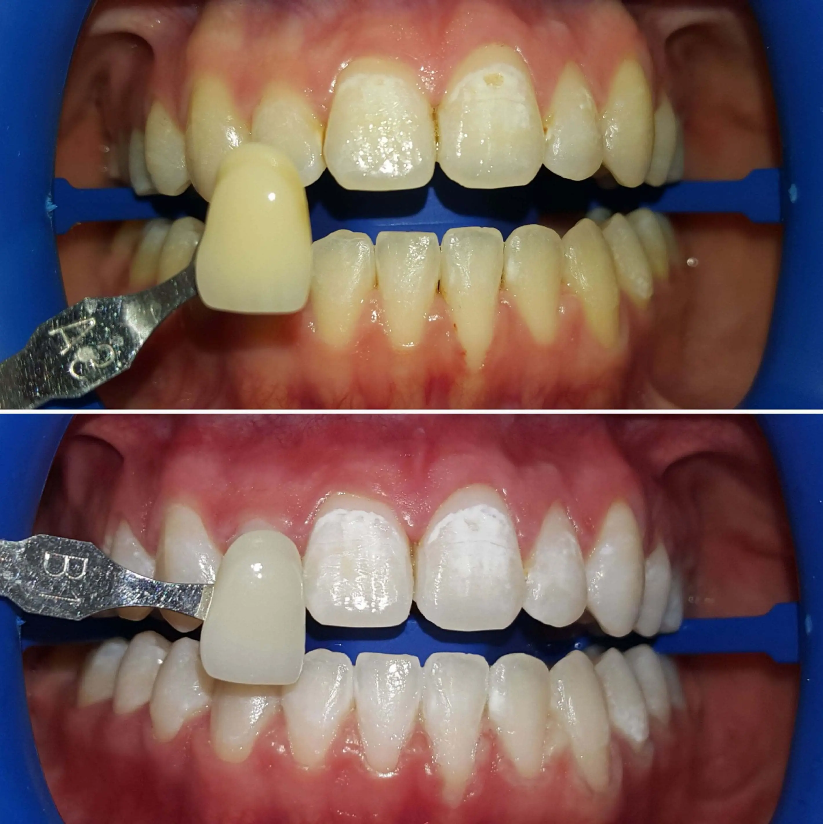 Teeth whitening results