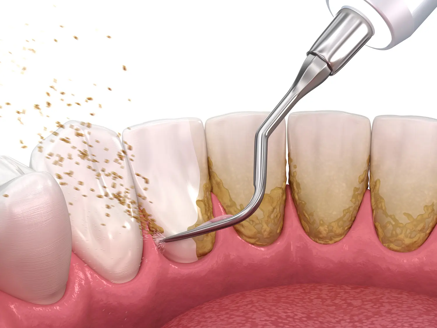 Teeth Scaling